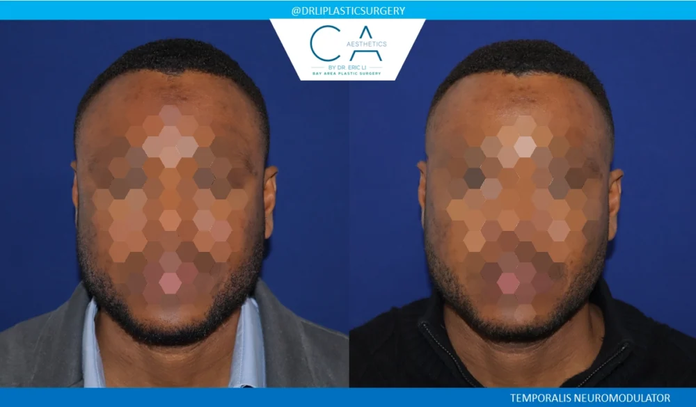 Botox case #8702