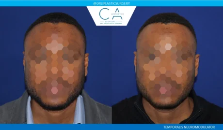 Botox case #8702