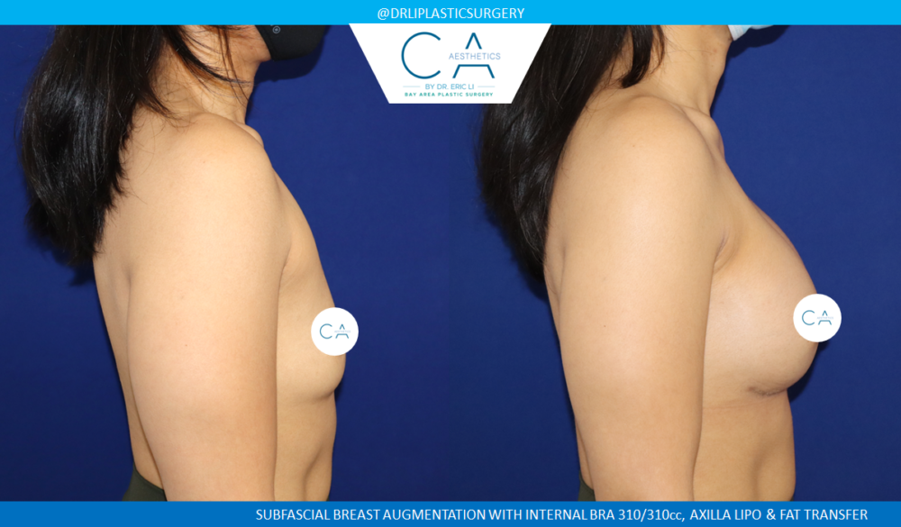 Asian Breast Augmentation case #8658
