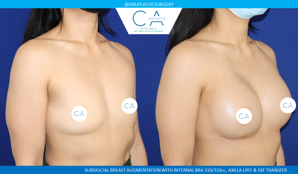 Asian Breast Augmentation case #8658