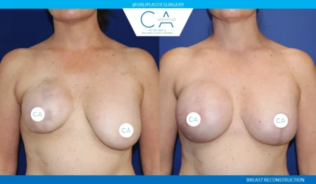 Breast Reconstruction case #8785