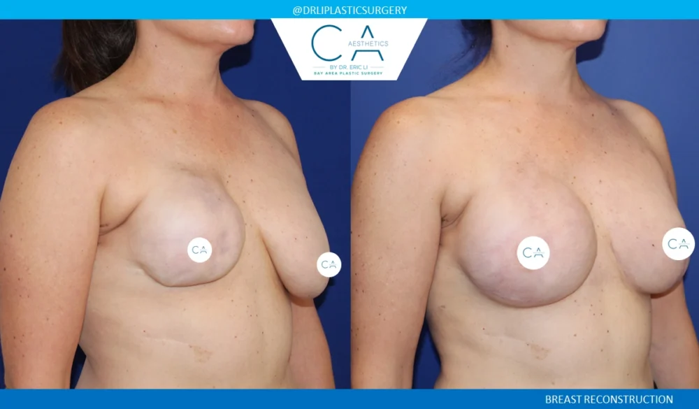 Breast Reconstruction case #8785