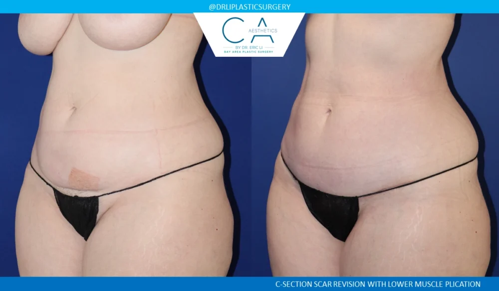 Tummy Tuck case #8694