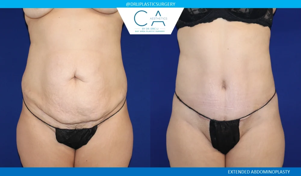 Tummy Tuck case #8690
