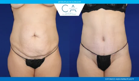 Tummy Tuck case #8690