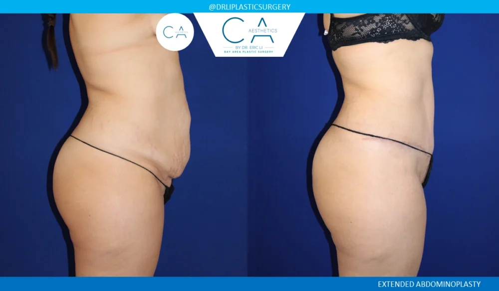 Tummy Tuck case #8690