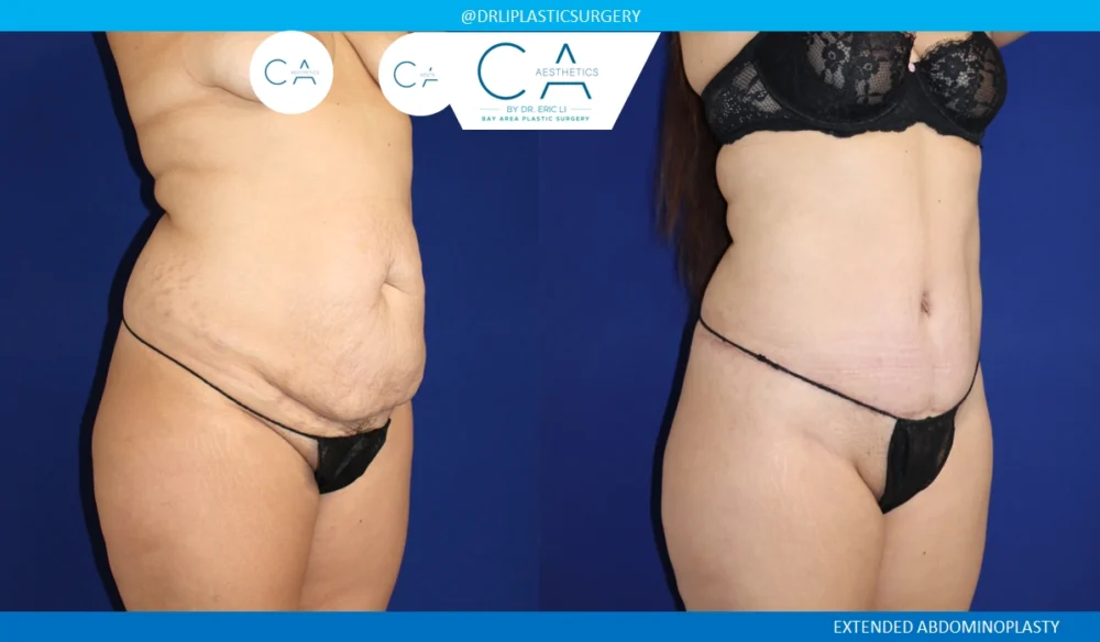 Tummy Tuck case #8690