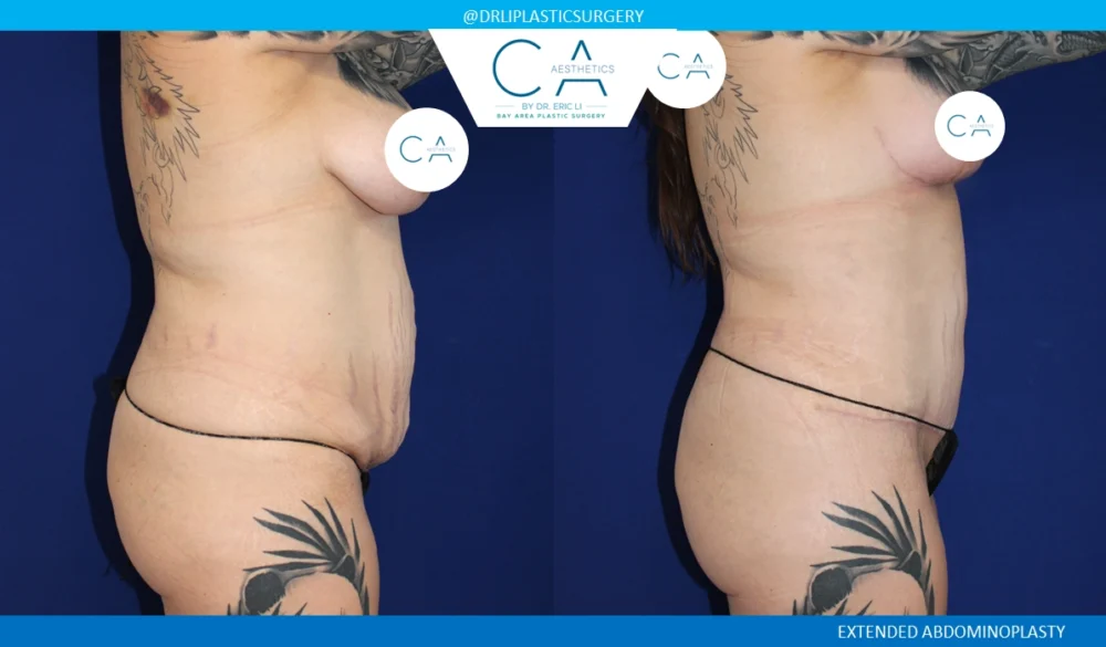 Tummy Tuck case #8687