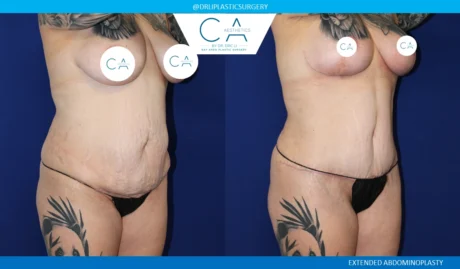 Tummy Tuck case #8687