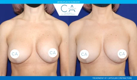 Breast Revision case #8805