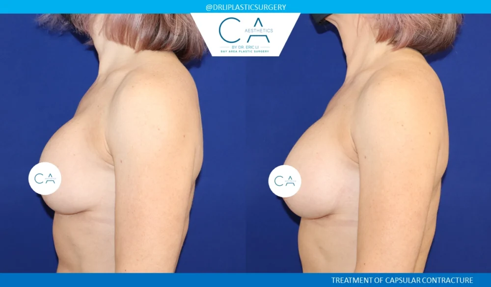 Breast Revision case #8805