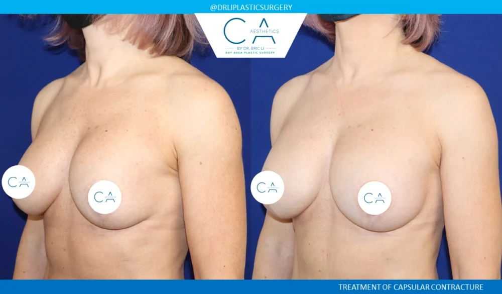 Breast Revision case #8805