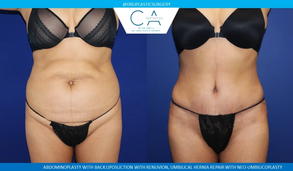 Tummy Tuck case #8683