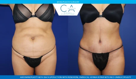 Tummy Tuck case #8683