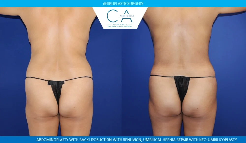 Tummy Tuck case #8683
