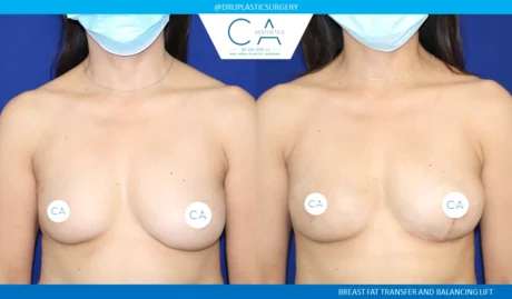 Breast Revision case #8809