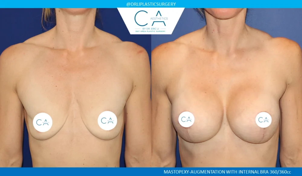 Breast Lift case #8784