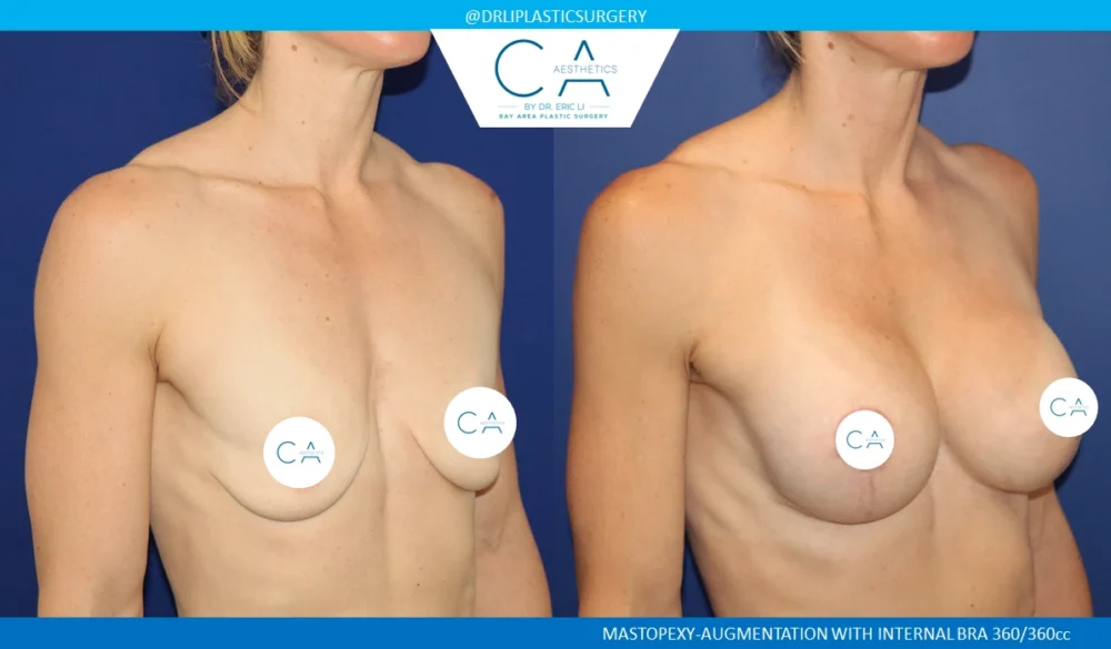 Breast Lift case #8784