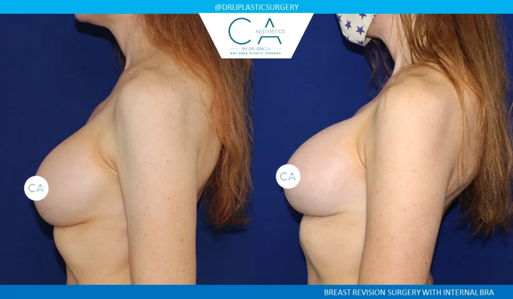 Breast Revision case #8811