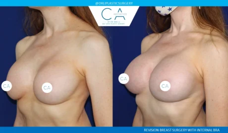 Breast Revision case #8811