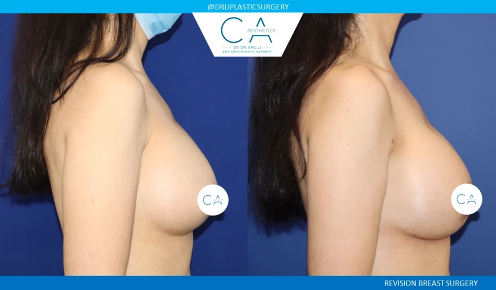 Breast Revision case #8814