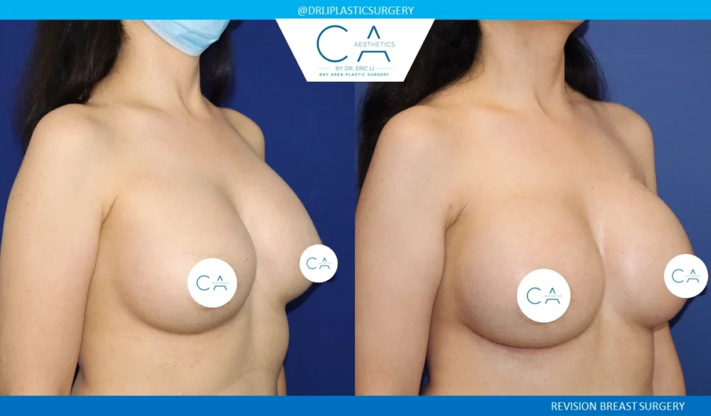 Breast Revision case #8814