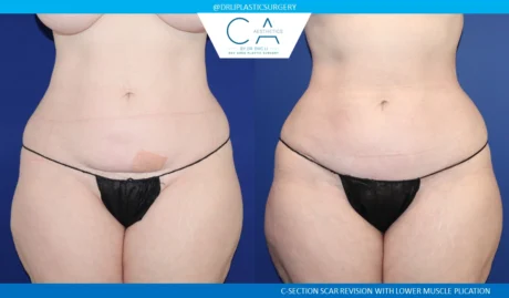Mole Removal and Scar Revision case #8820