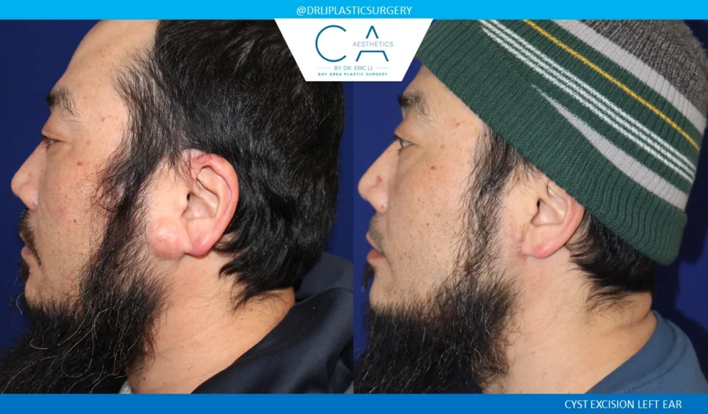Mole Removal and Scar Revision case #8823