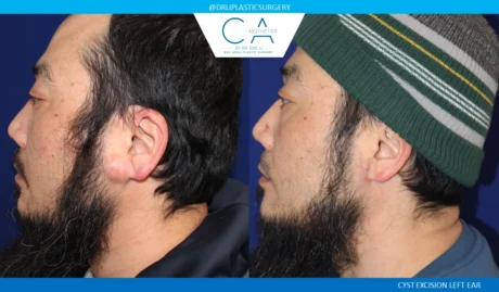 Mole Removal and Scar Revision case #8823