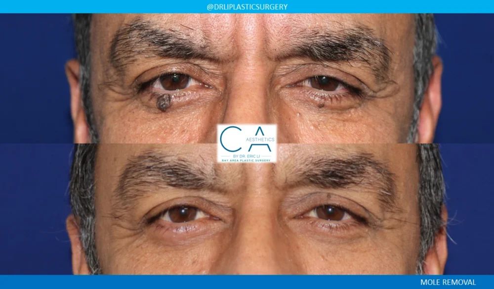 Mole Removal and Scar Revision case #8681