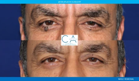 Mole Removal and Scar Revision case #8681