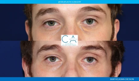 Mole Removal and Scar Revision case #8825