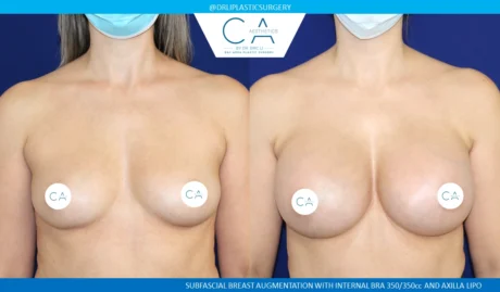 Breast Augmentation case #8716