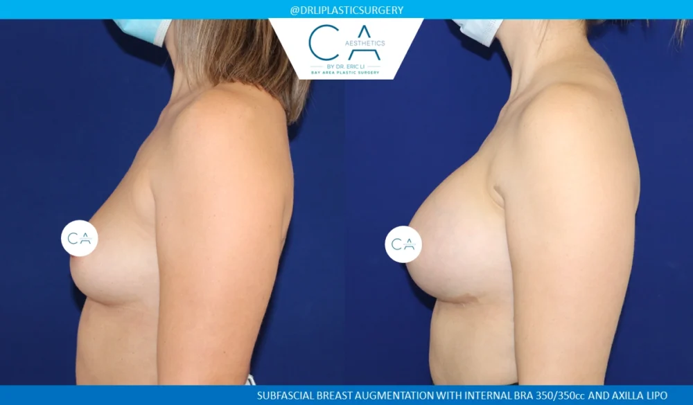 Breast Augmentation case #8716