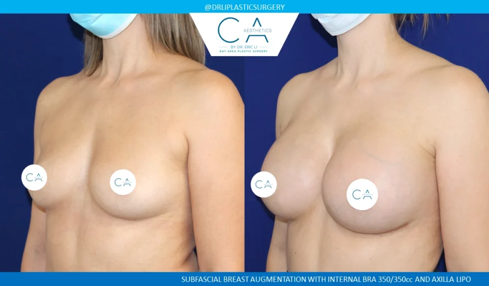 Breast Augmentation case #8716