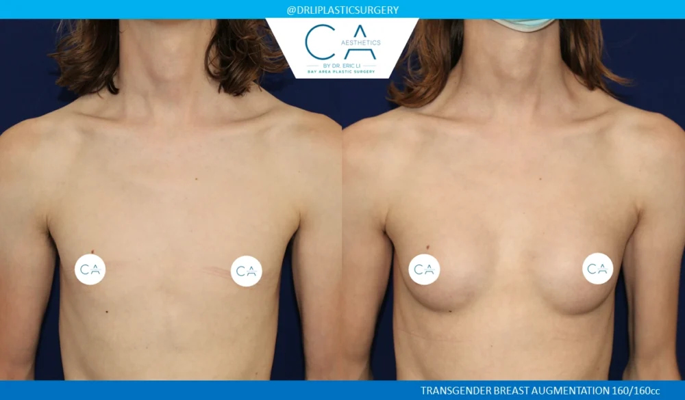 Male to Female Top Surgery case #8712