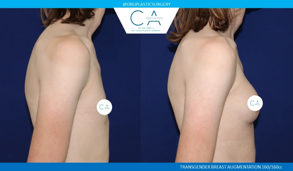 Male to Female Top Surgery case #8712