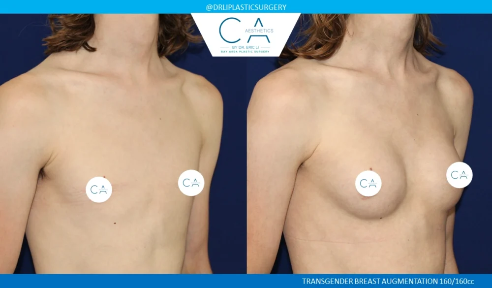 Male to Female Top Surgery case #8712