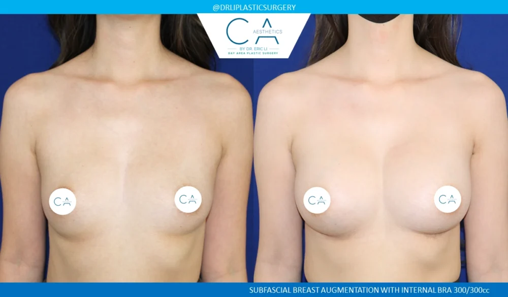 Breast Augmentation case #8730