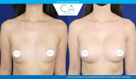 Breast Augmentation case #8730