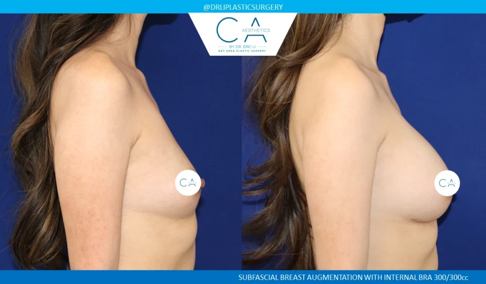 Breast Augmentation case #8730