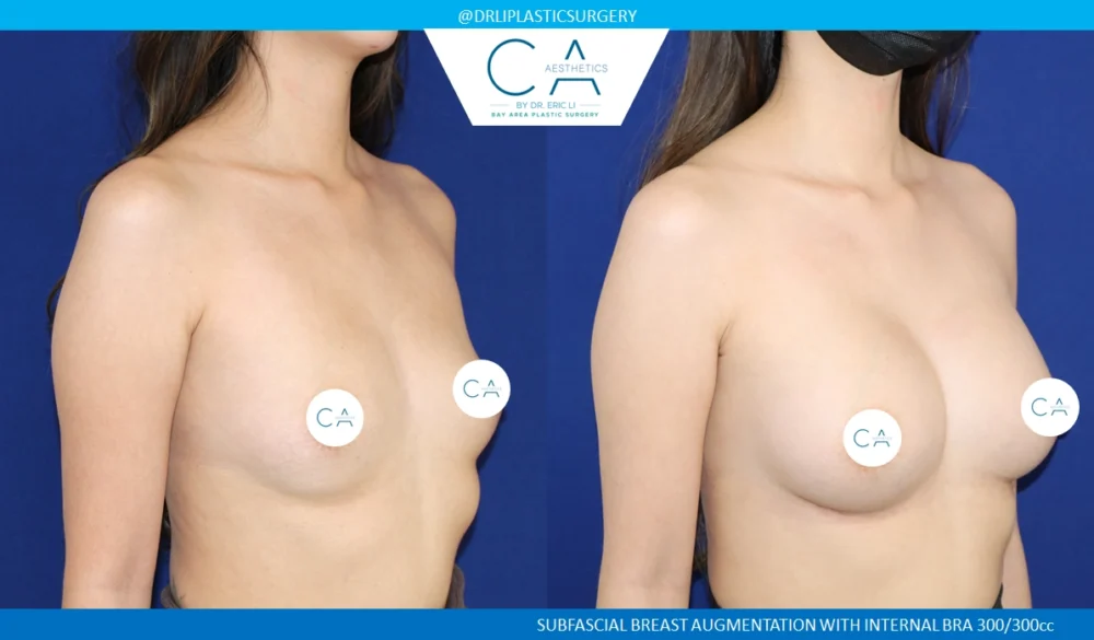 Breast Augmentation case #8730
