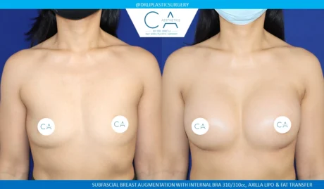 Breast Augmentation case #8731
