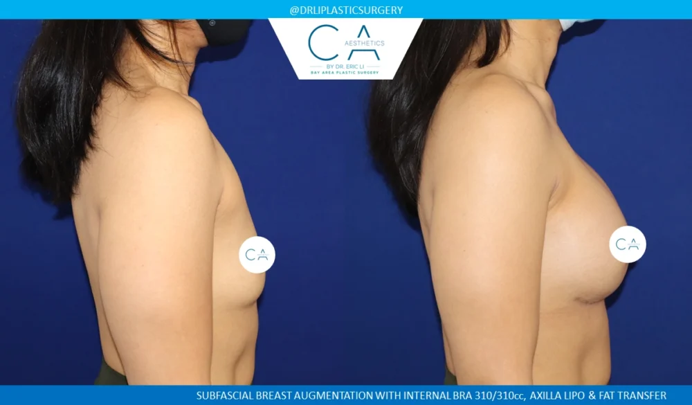 Breast Augmentation case #8731