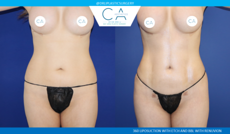 360 Liposuction (Torso) case #8645