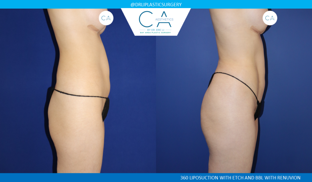 360 Liposuction (Torso) case #8645
