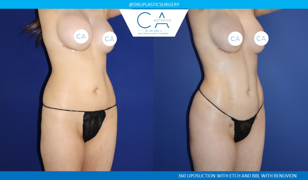 360 Liposuction (Torso) case #8645