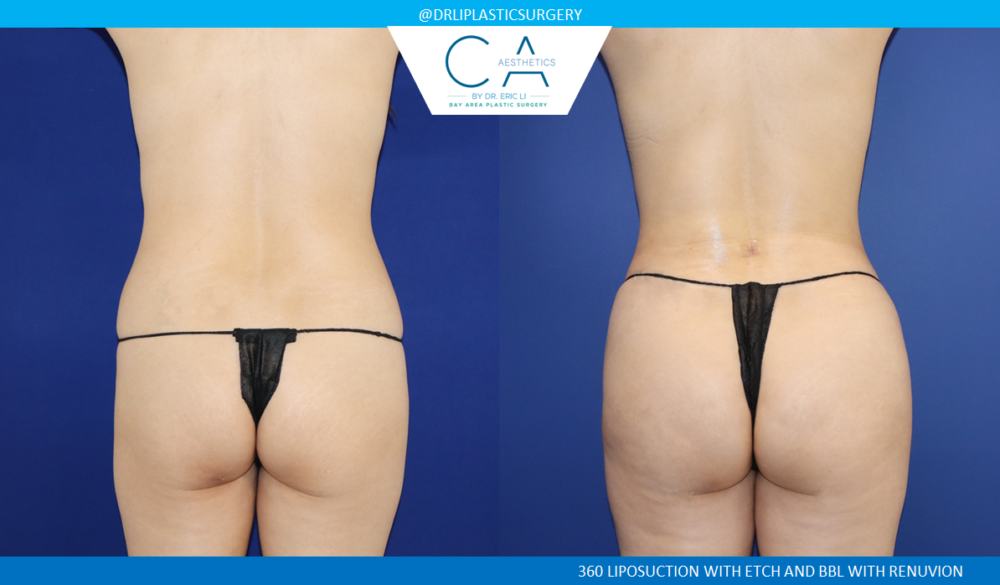 360 Liposuction (Torso) case #8645