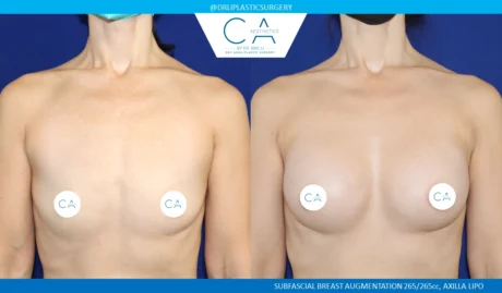 Breast Augmentation case #8732