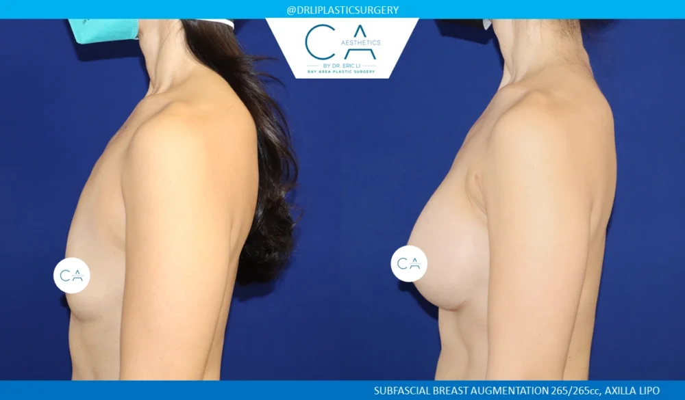 Breast Augmentation case #8732